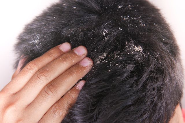 Dandruff hair problem